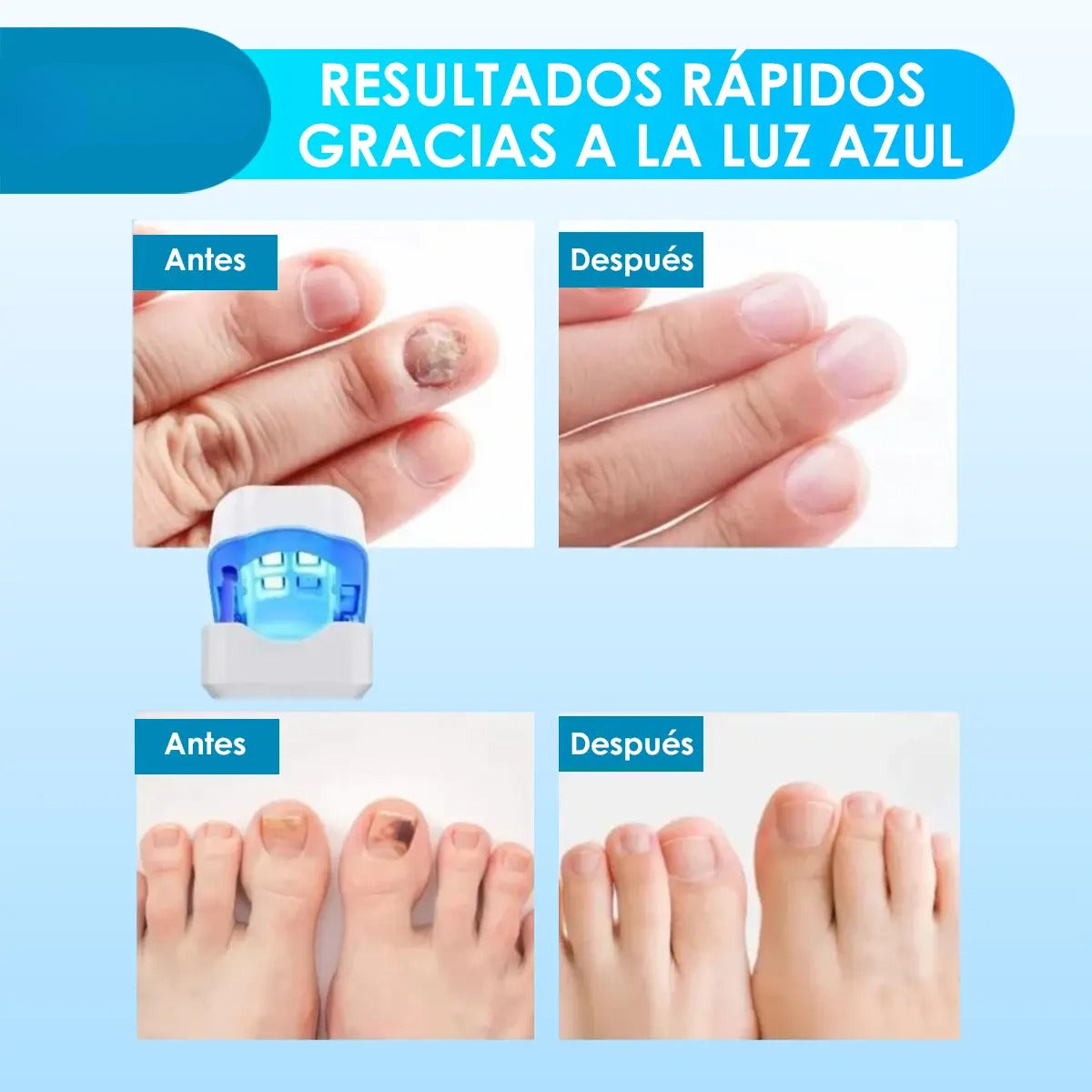 Láser de hongos de uñas